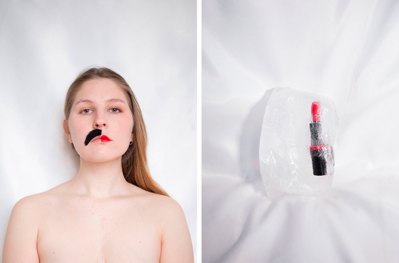 Случаи поликистоза яичников иногда остаются недиагностированными