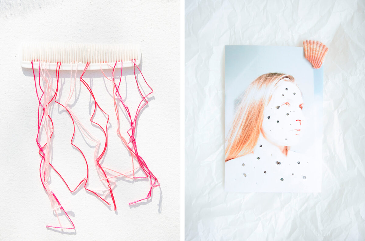 Женщинам с&nbsp;синдромом поликистоза яичников на&nbsp;протяжении всей жизни вновь и&nbsp;вновь приходится сталкиваться с&nbsp;акне