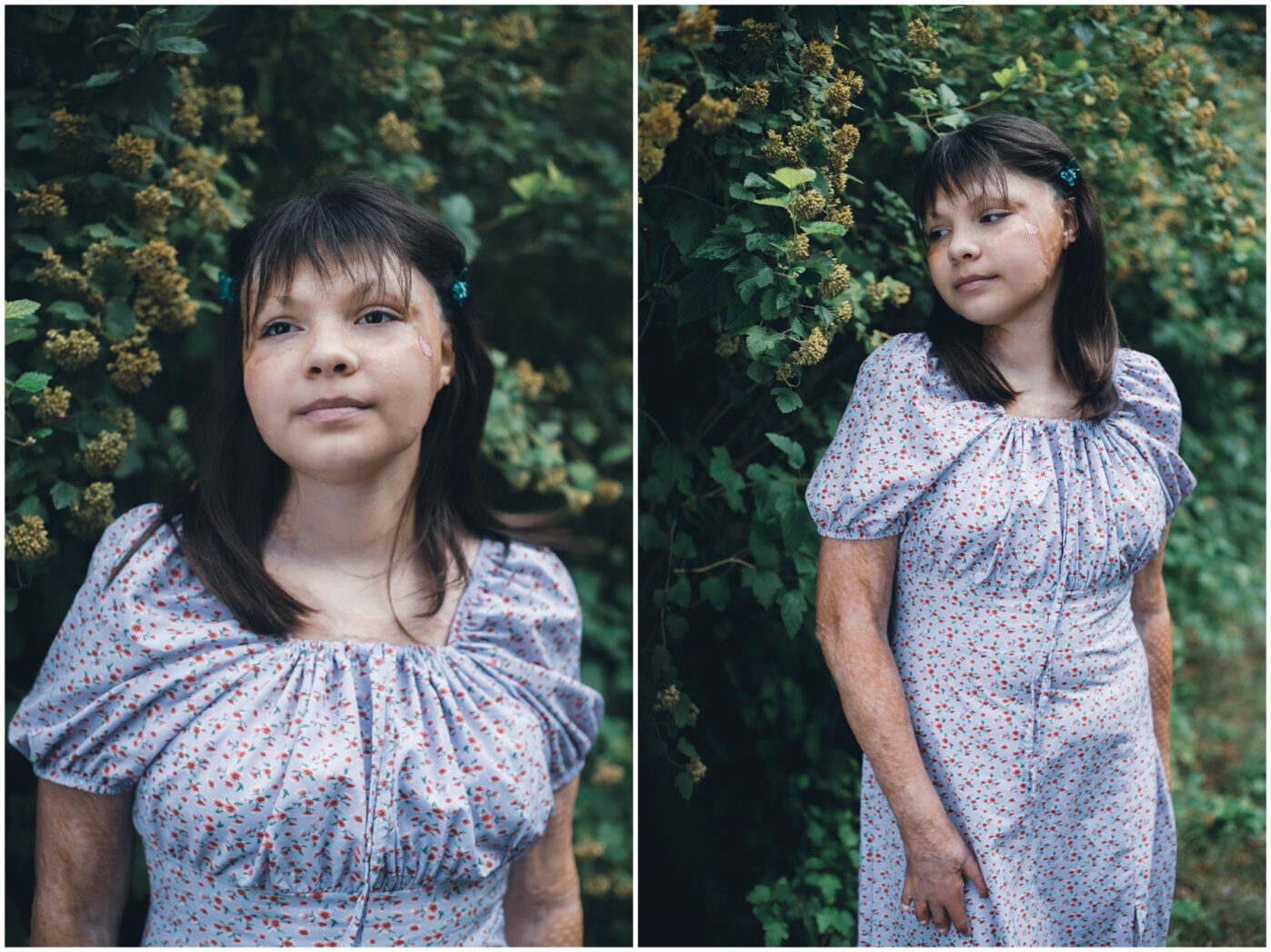 В&nbsp;Ярославской области работает единственный в&nbsp;России лагерь для детей с&nbsp;ожогами. Его организовал фонд «Детская больница» при больнице имени Сперанского